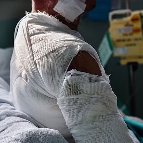 شدید جلے جسم پر جِلد لگانے کا نیا طریقہ کار وضع