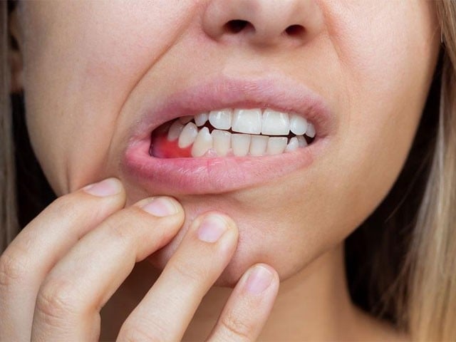کولیسٹرول قابو کرنیوالی ادویات مسوڑھوں کی بیماری میں مفید قرار