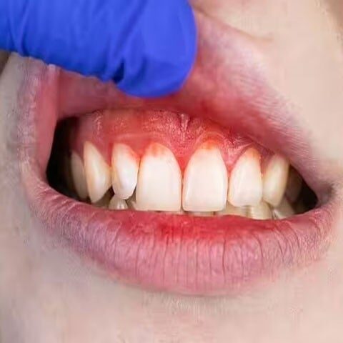 مسوڑھوں کی بیماری دماغی صحت کے لیے مسائل کھڑے کر سکتی ہے