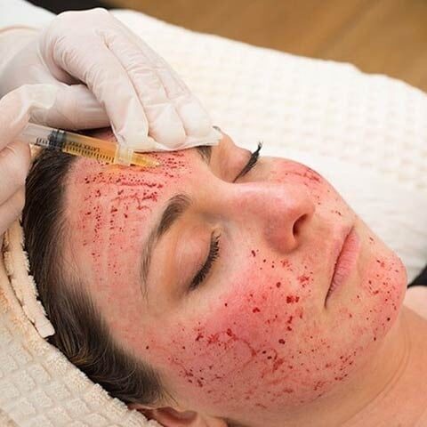 ویمپائر فیشل سے ایچ آئی وی اور دیگر انفیکشن میں اضافہ