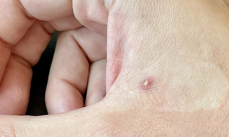 پنجاب حکومت نے منکی پاکس کے حوالے سےکمیٹی تشکیل دے دی