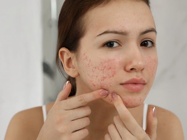 مہاسوں کیلئے استعمال کی جانے والی مصنوعات کینسر کا باعث بن سکتی ہیں