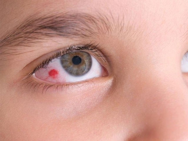 ذیابیطس میں مبتلا افراد کے آنکھوں کے زخم دیر سے کیوں بھرتے ہیں؟